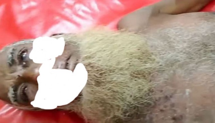 কালকিনিতে কোদালের কোপে বোমা বিস্ফোরিত হয়ে কৃষক আহত " এলাকায় আতঙ্ক