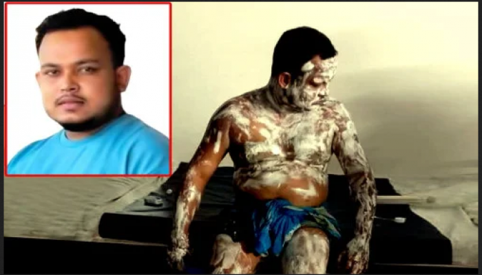 কটিয়াদীতে গ্যাস সিলিন্ডার বিস্ফোরণে দগ্ধ কাউছারের মৃত্যু