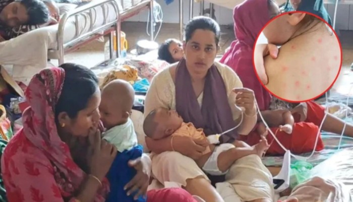 ৫ মাসে হাম ও হামের উপসর্গে মৃ'ত্যু ৯৫৫